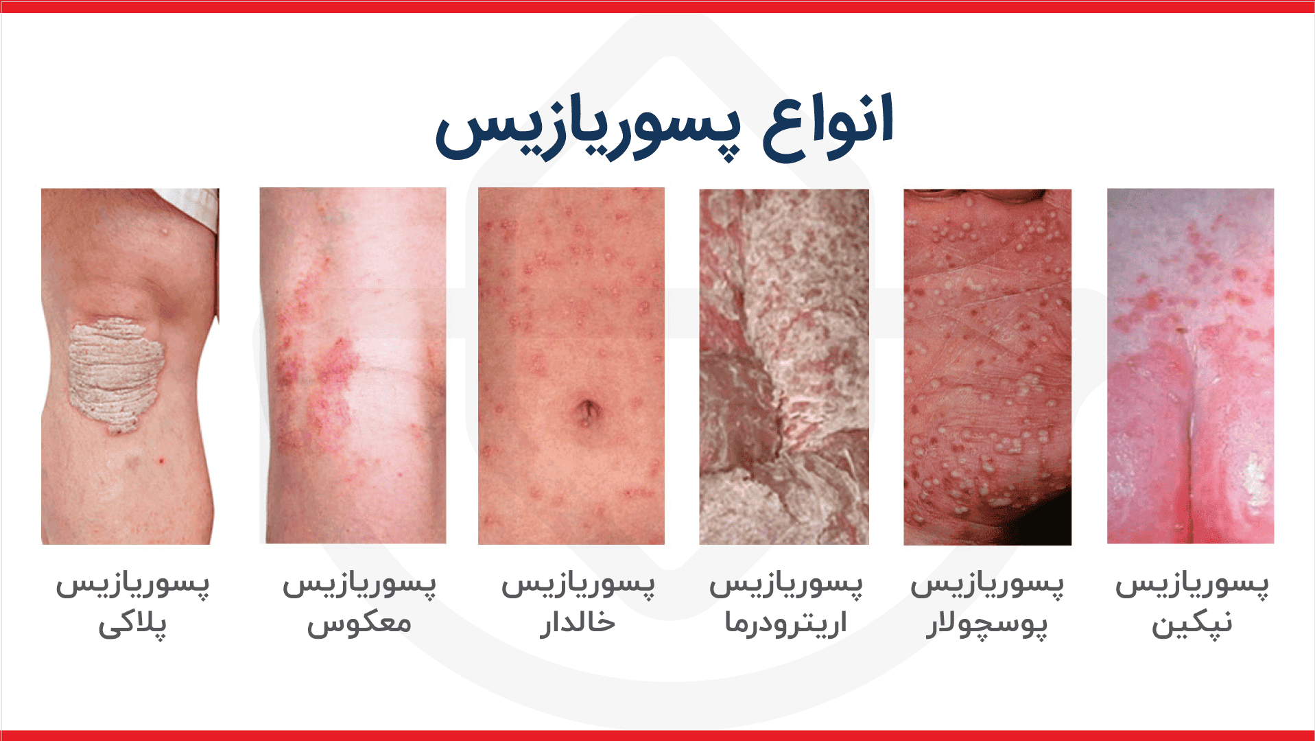 انواع پسوریازیس با عکس